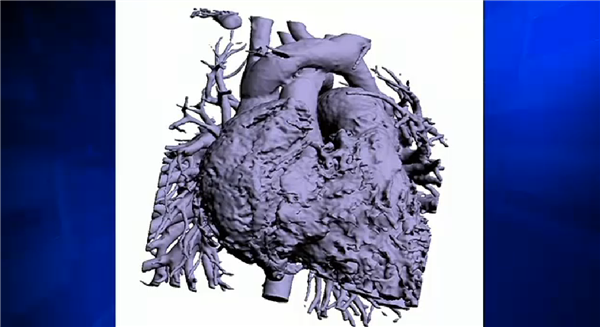 Врачи использовали 3D-печать для успешного проведения операции на открытом сердце четырехлетней девочки