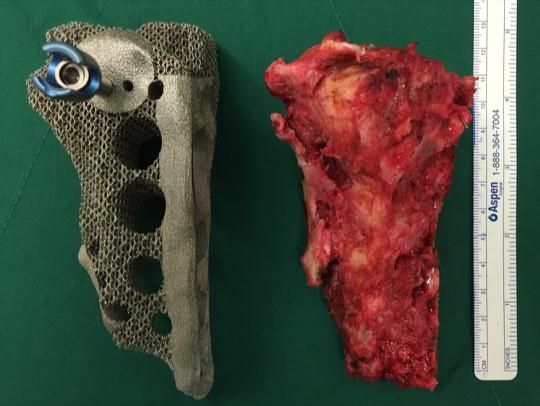 Korean Doctors Successfully Implant 3D Printed Pelvis