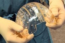 Девушке поставили новый череп, напечатанный на 3D-принтере