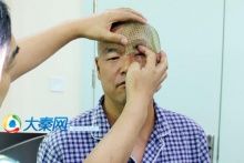 Врачи восстановили форму черепа пациента с помощью 3D-печатной титановой сетки